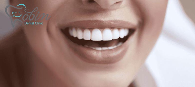 مراقبت های بعد از کامپوزیت دندان 